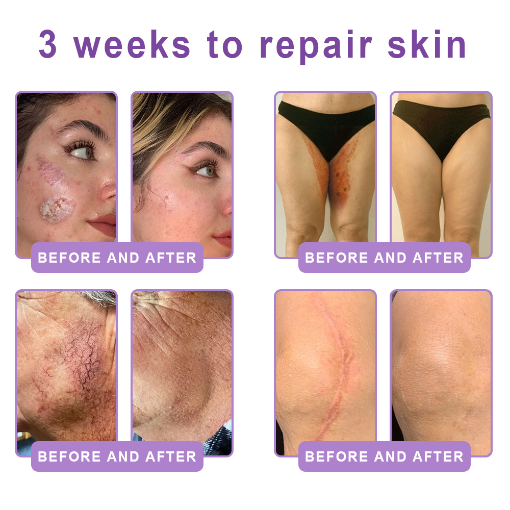 🔥Vitalisys® PDRN Multi-Peptide Massaging Body Roller Cream- Anti-aging, 🙆‍♀️Hydrating, Skin Firming & Lifting, Skin Repair, Even Tone, Acne and Dark Spot Treatment, Wart and Mole Removal, and Psoriasis Relief